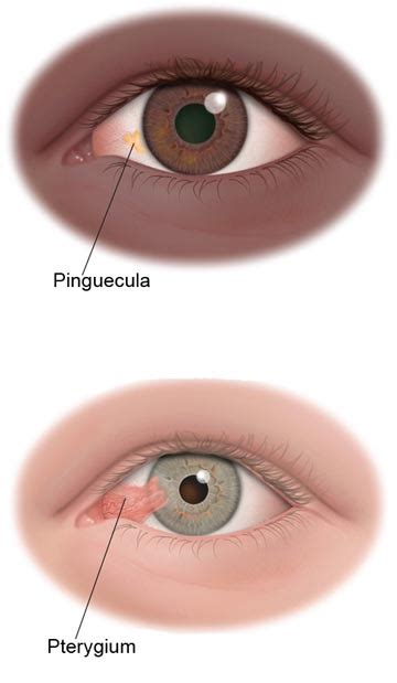 Pinguecula and Pterygium - South Bay Ophthalmology