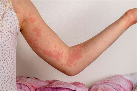 Autoimmune Hives: Symptoms, Causes, and Treatment