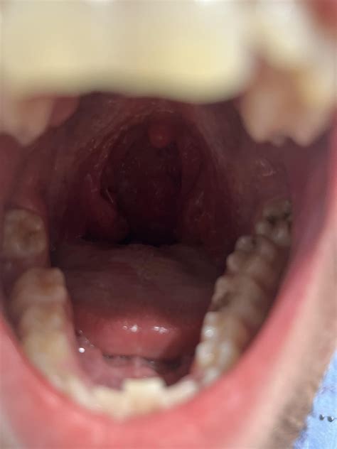 Swollen tonsil and slightly swollen lymph node. Male age 25. : r/medical_advice