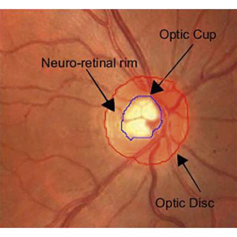 Structure of optic nerve head: (a) normal and (b) glaucoma [3 ...