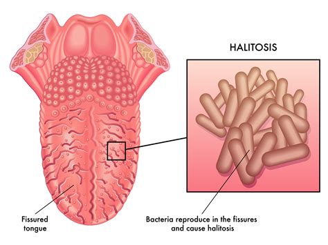 What is a Fissured Tongue?