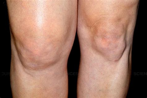 Patellofemoral pain syndrome - cargover