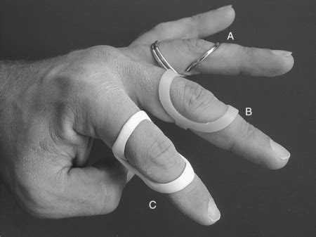 Splinting for the Fingers | Musculoskeletal Key