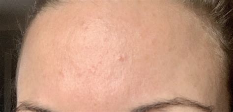 Sebaceous Hyperplasia treatment, other laser treatments ? : 30PlusSkinCare