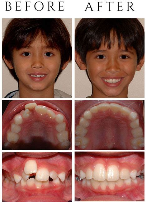 Palate Expander Before And After