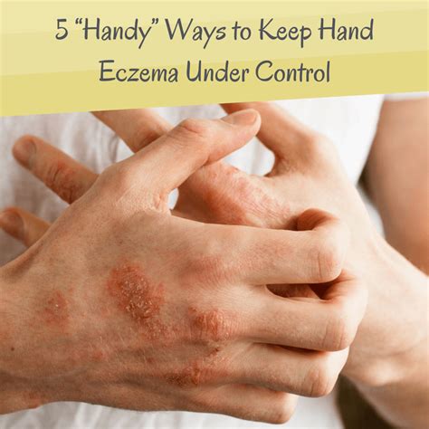 5 “Handy” Ways to Keep Hands Eczema Under Control - It's an Itchy ...