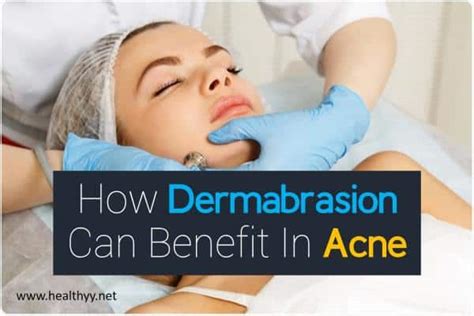 How Dermabrasion Can Benefit In Acne