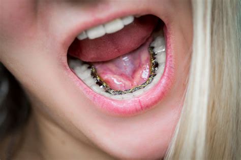 Lingual Braces: Pros And Cons, Cost, Comfort, Lisping, And, 47% OFF