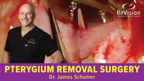 Pterygium Removal *WATCH SURGERY* - YouTube