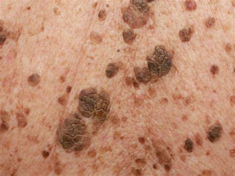 Seborrheic Keratosis - Causes, Symptoms, Home Treatment