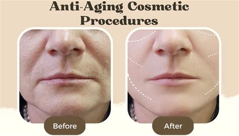 Top 4 Anti-Aging Cosmetic Procedures for Women over 50