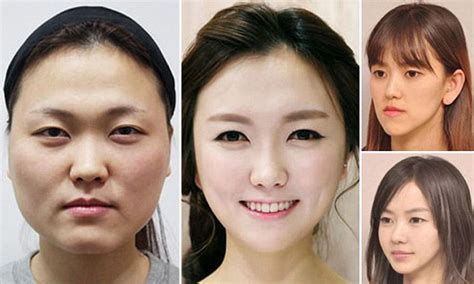 Korean Artist Plastic Surgery Before And After