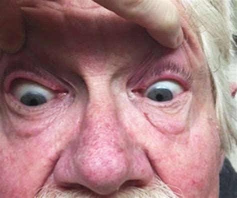 Opsoclonus-Myoclonus Syndrome In 71-Year-Old Patient