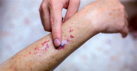 Purpuric Rash Causes, Pictures, and When to Get Medical Help