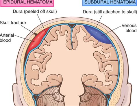 What Is The Treatment For Epidural Hematomas - Ronald Hall Bruidstaart