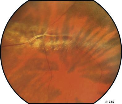 Peripheral Retinal Degenerations and Rhegmatogenous Retinal Detachment ...