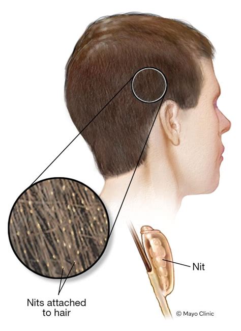 Head Lice Nits Vs Eggs