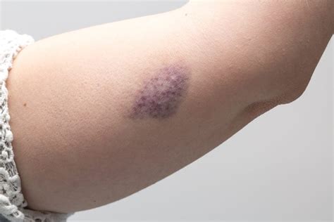 What the Color of Your Bruise Is Trying to Tell You | Reader's Digest