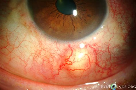 Diffuse Scleritis