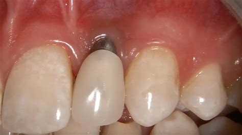 Upper central incisor implant esthetic correction