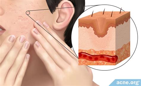 What Causes a Pimple to Scar? - Acne.org