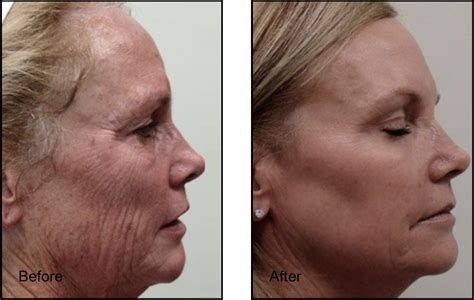 Fractional CO2 Laser Resurfacing in Beverly Hills CA