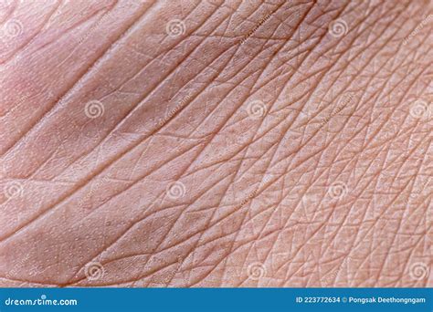 Closeup View of Feet with Dry Skin Cracks Stock Photo - Image of closeup, hygiene: 223772634