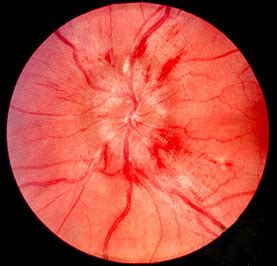 Papilledema - Wikipedia