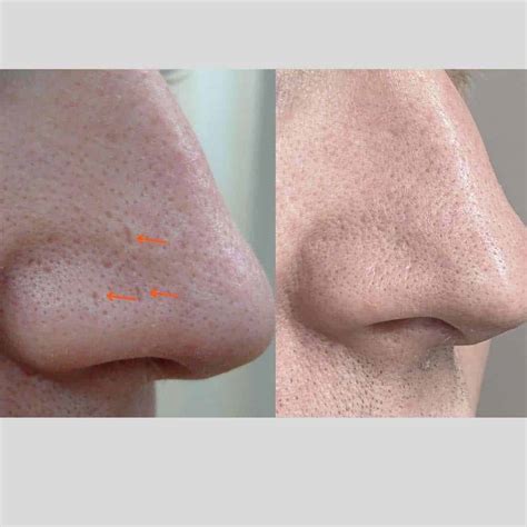 Best Enlarged Pores Treatment In Australia | Dr Davin Lim