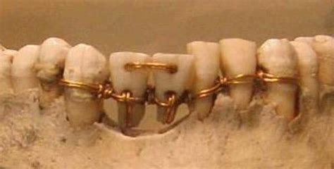 Dentistry in Ancient Egypt