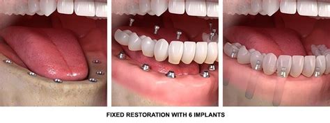 Full Mouth Dental Implants Stuart, FL | Teeth in a Day | Dr. James Horan