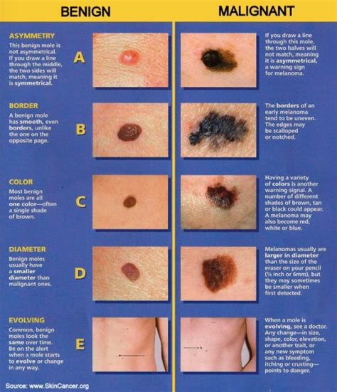 Benign Nevus Vs Melanoma