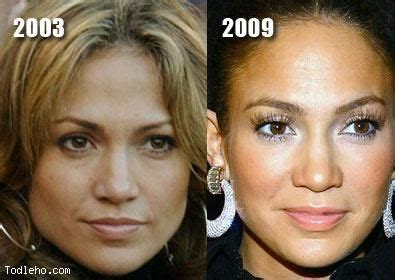 Jennifer Lopez Botox Before After