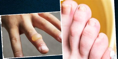 How To Treat A Burn Blister? Try These Effective Remedies | Onlymyhealth