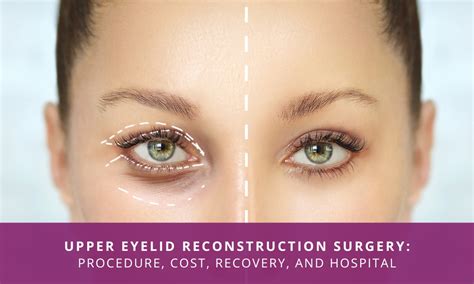 Upper Eyelid Reconstruction Surgery | Procedure, Cost, Recovery, and ...