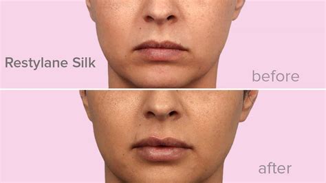 Restylane vs. Juvederm for Lips: What’s the Difference?