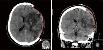 Predictive factors for decompressive hemicraniectomy in malignant ...