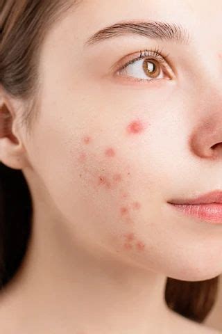What Causes Pimples On The Face? in 2021 | What causes pimples, Pimples on face, Face mapping acne