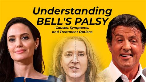 Understanding Bell's Palsy: Causes, Symptoms, and Treatment Options - YouTube