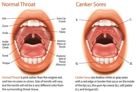 Best Canker Sore Treatment In India | Mouth Sore Cure Near Me