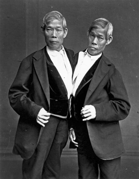 siamese twins - Google Search | Freak show, Human oddities, Conjoined twins