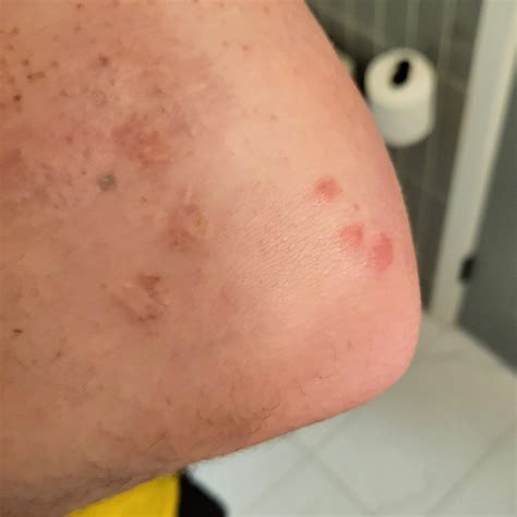 Mosquito bites mirror my elbow scars : r/mildlyinteresting