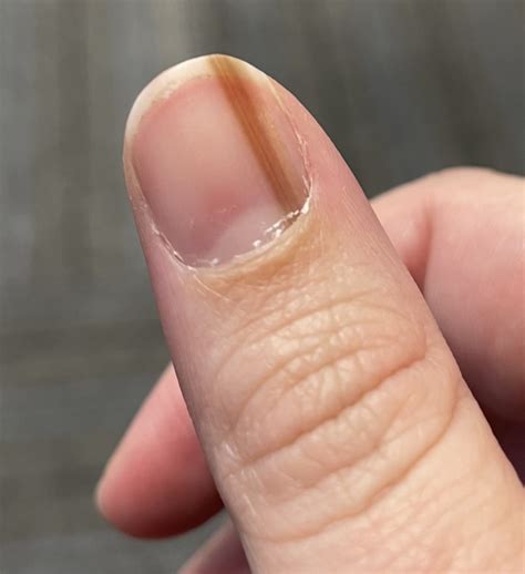 Subungual Melanoma: Tan Streak On Woman's Nail Was Skin Cancer