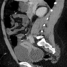 CT scan sagittal reformatted image shows the hematocolpos posterior to ...