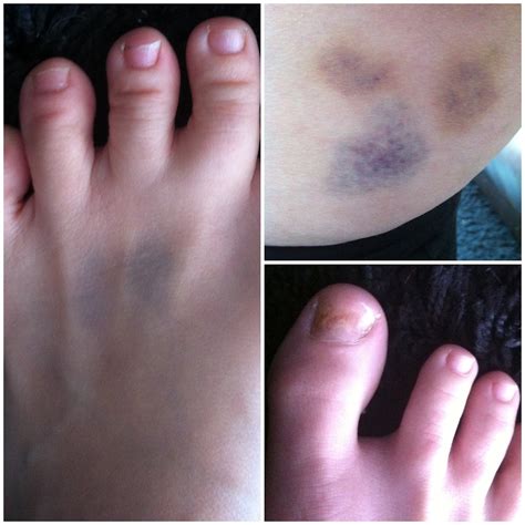 Accidental Wonderland: Derby Bruises