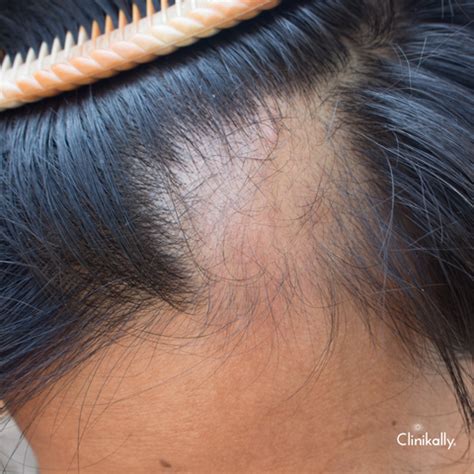 Redensyl for Hair Loss: Benefits, Side Effects & How to Use | Clinikally