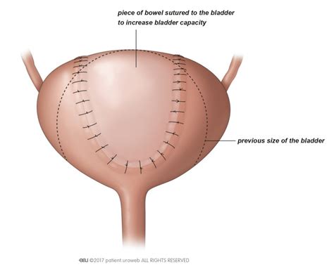 Overactive bladder syndrome - Patient Information