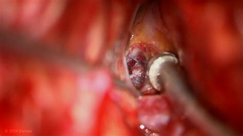 #297: Mini Pterional Craniotomy and Transsylvian Approach for Resection ...