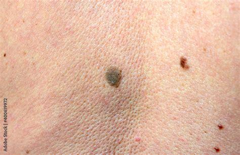 close up the black spot on human back skin. Melanoma is a type of skin cancer develops on human ...