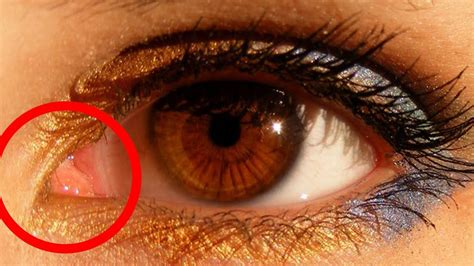 Caruncle Eye Swollen - Infoupdate.org